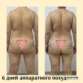Фото до и после LPG аппаратный массаж для похудения Школа Мария Андреевна салон Мерси Ростов на дону